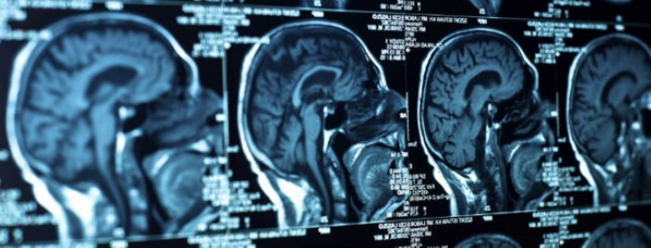 Brains as seen on fMRI
